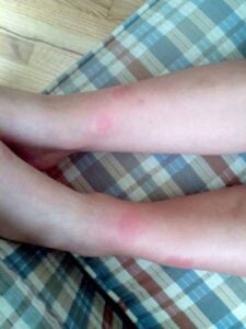 Cellulitis mosquito bites